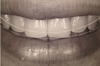 唇と歯の関係（Lip to Tooth Relationship）